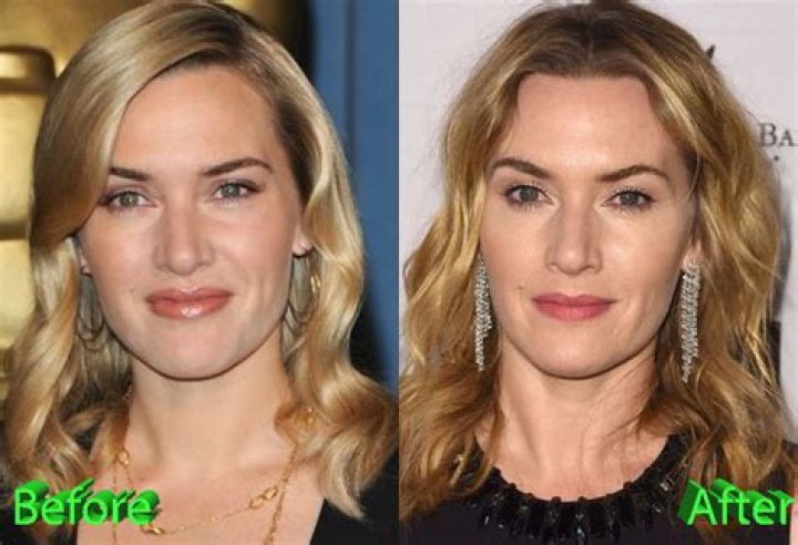 Kate Winslet Plastic Surgery: Embracing Age and Defying Hollywood Norms