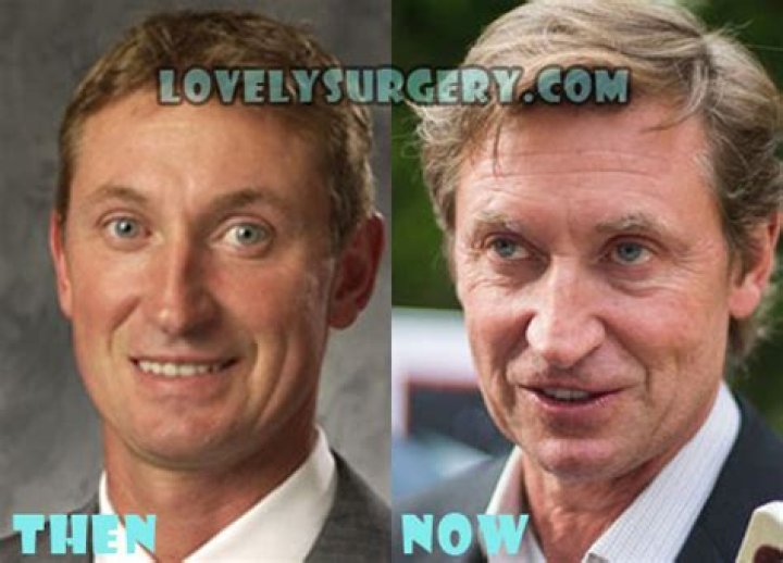 Wayne Gretzky Plastic Surgery: An Overdo of Facelift or Something Wrong with His Face?